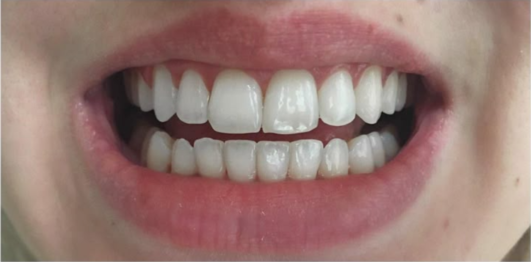 Before treatment