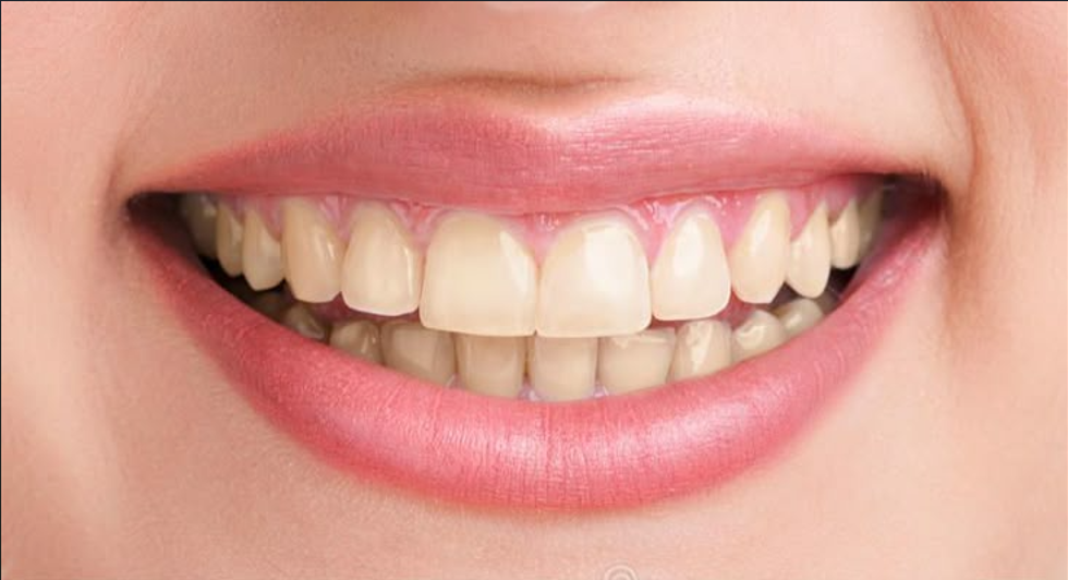 After whitening treatment