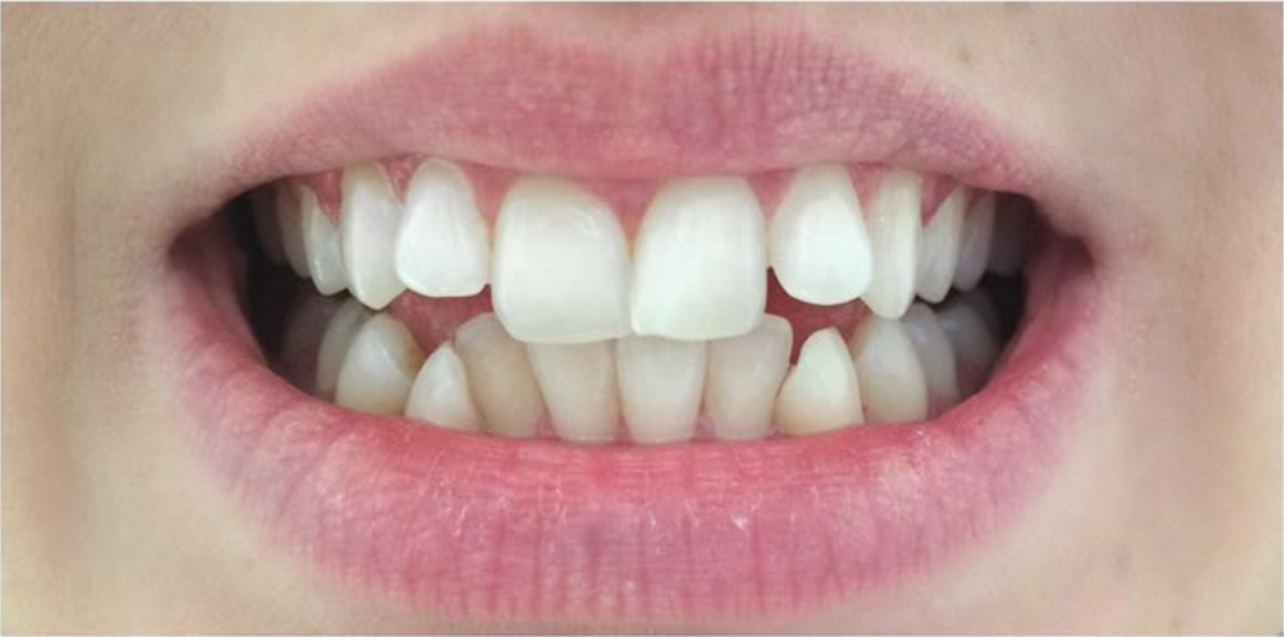After treatment